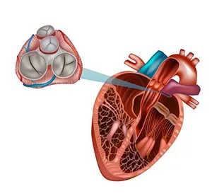 Invasive Heart Surgeries