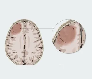Diagram of brain highlighting brain location