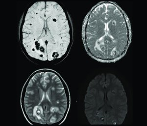 MRI image of brain showing different areas