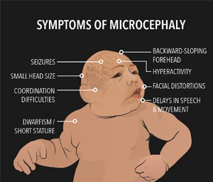 Visual representation of microcephaly symptoms, including small head size and developmental delays.