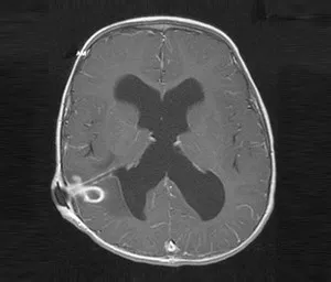 MRI image of a brain on a black background