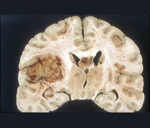  An image of a brain with a large tumor in the middle