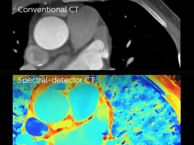 Conventional CT vs spectral-detector CT