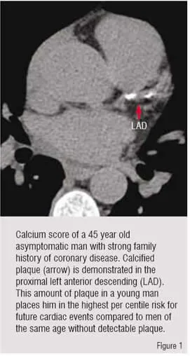 Calcium scoring, a popular method of cardiac evaluation using Electron Beam CT technology