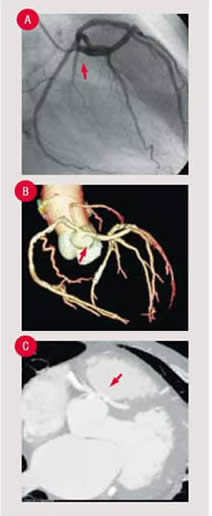 Invasive Cardiac catheterisation(Panel A), 3D Reconstruction(Panel B) and axial image(Panel C) of a patient with a single coronary artery.
