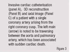 The left mailn arrow is noted to be traversing between the aorta and pulmonary artery, whisn has the associated with sudden cardiac death