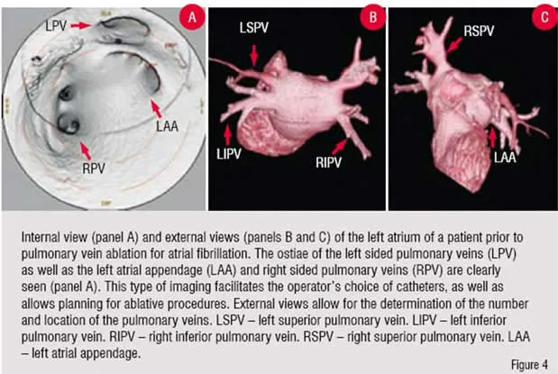 Internal View(Panel A) and External Views(Panel B and C) of the left sided pulmonary vein ablation for atrial fibrillation.