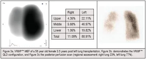 VRIXP MEF of a 56 year old female 3.5 years post left lung transplantation