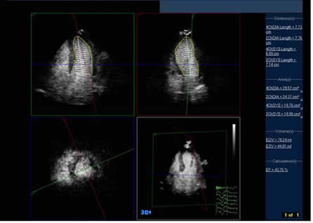 Improved endocardial delineation following SonoVue infusion