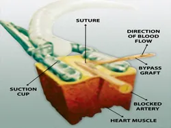 Off-pump CABG is performed with the help of various mechanical stabilisers.