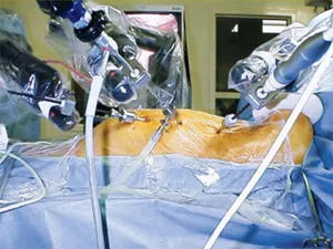 Robotic Cardiac Surgery 2