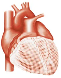 Cardiac wrap surgery