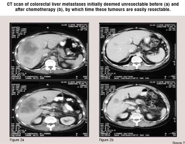 CT scan of colorectal liver metastases initially deemed unresectable