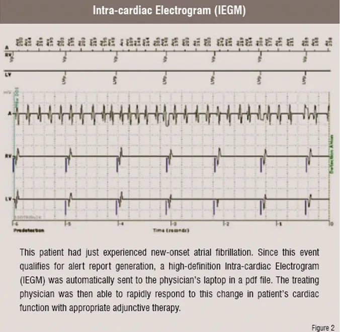 intra_cardiac