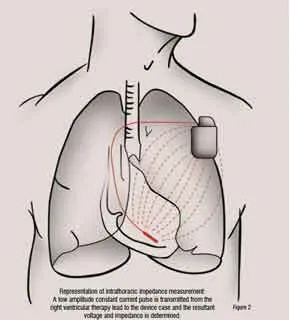 Intrathoracic impedance measurement
