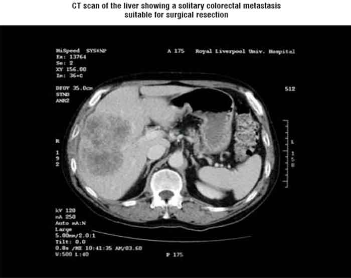 CT scan of the liver showing a solitary colorectal metastasis suitable for surgical resection