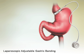 Laparoscopic Adjustable Gastric Banding 