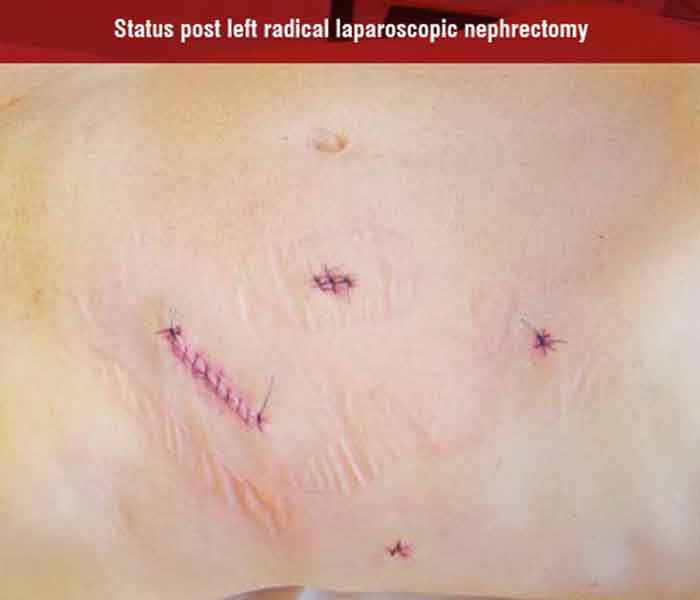 Left radical laparoscopic nephrectomy