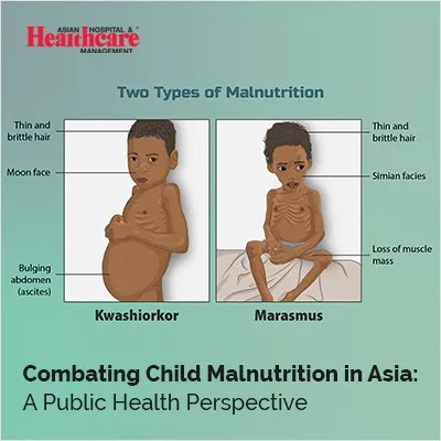 Illustration of two types of child malnutrition, Kwashiorkor and Marasmus, with symptoms labeled.