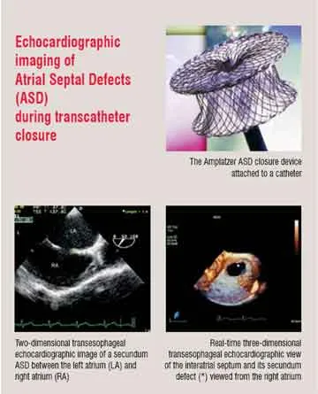 Atrial Septal Defects