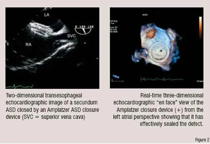 Atrial Septal Defects