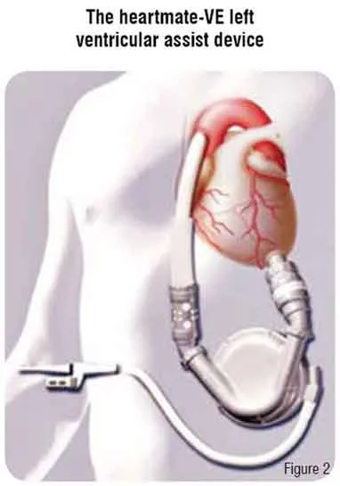 Heartmate Ve Left Ventricular Assist Device