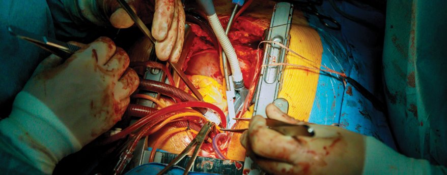 Surgeon Volume in Multi-Arterial Revascularisation and Long-Term Survival
